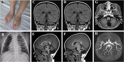 Case Report: Evidences of myasthenia and cerebellar atrophy in a chinese patient with novel compound heterozygous MSTO1 variants